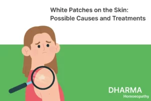 Read more about the article White Patches on the Skin: Possible Causes and Treatments