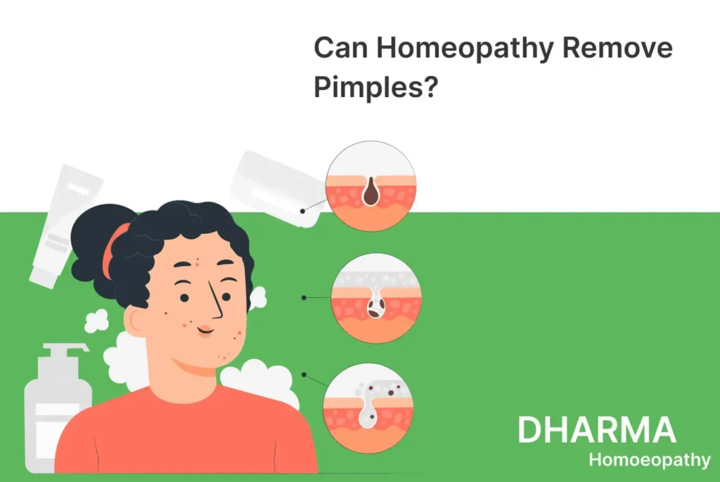 Homeopathy for Pimples